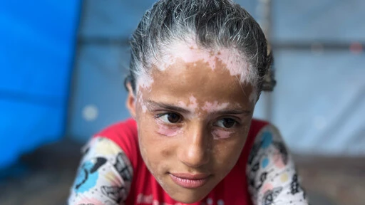 ‘Elderly child’: Trauma of Israeli bombing turns Gaza girl’s hair grey