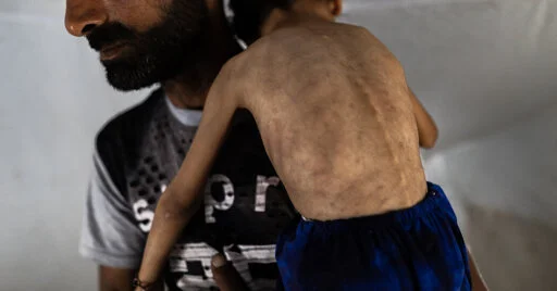 In Gaza’s Emaciated Children, a Hunger Crisis Is Laid Bare